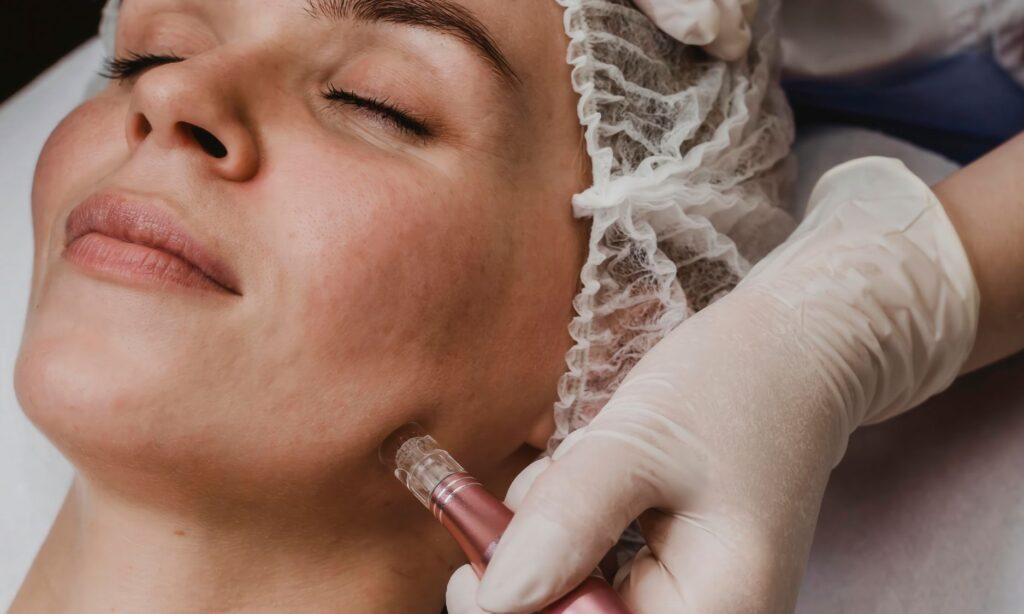 microneedling treatment on face