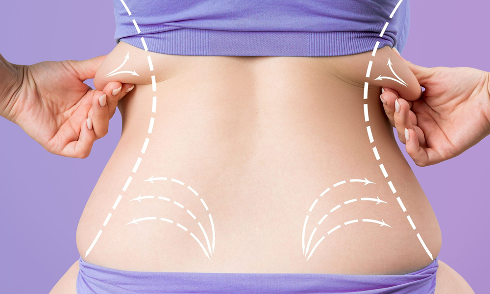 Post Liposuction Recovery at Dermathetics, medical aesthetics clinic in Farringdon, London